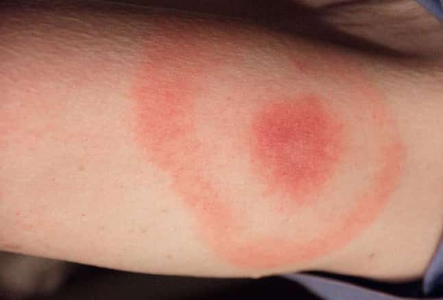 Tick-borne illnesses, including Lyme disease and Rocky Mountain Spotted Fever, are rising in Alabama 5 Birmingham, Alabama, Lyme disease, ticks, ticks in Alabama